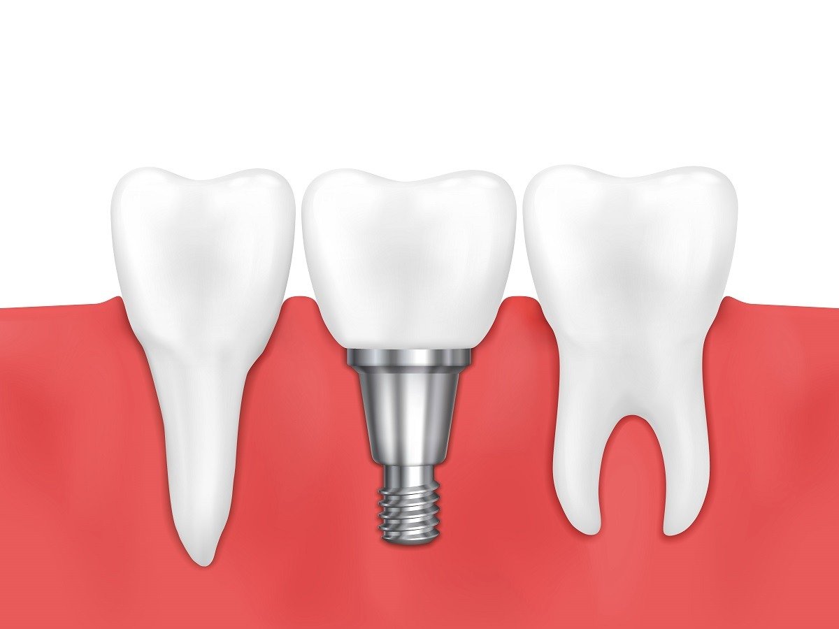 dental implants