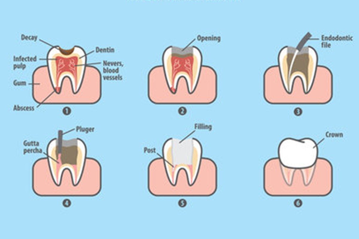 Tooth structure