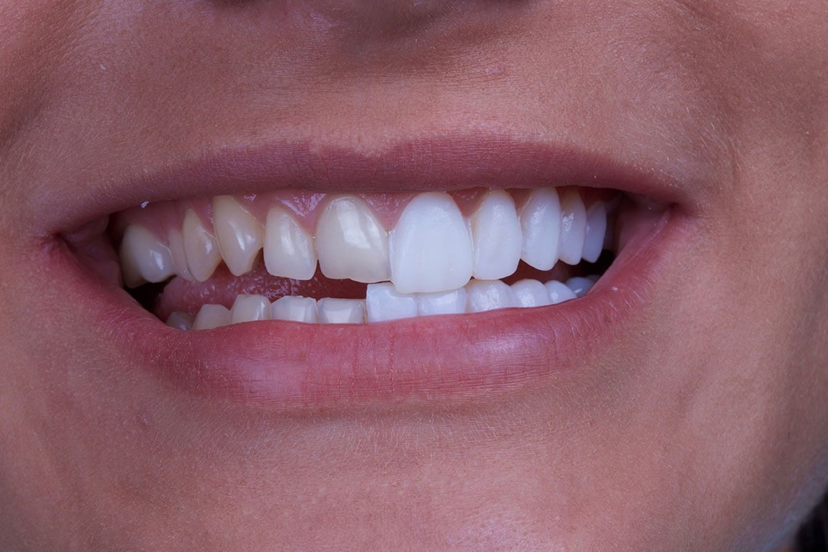 Cavities on front teeth