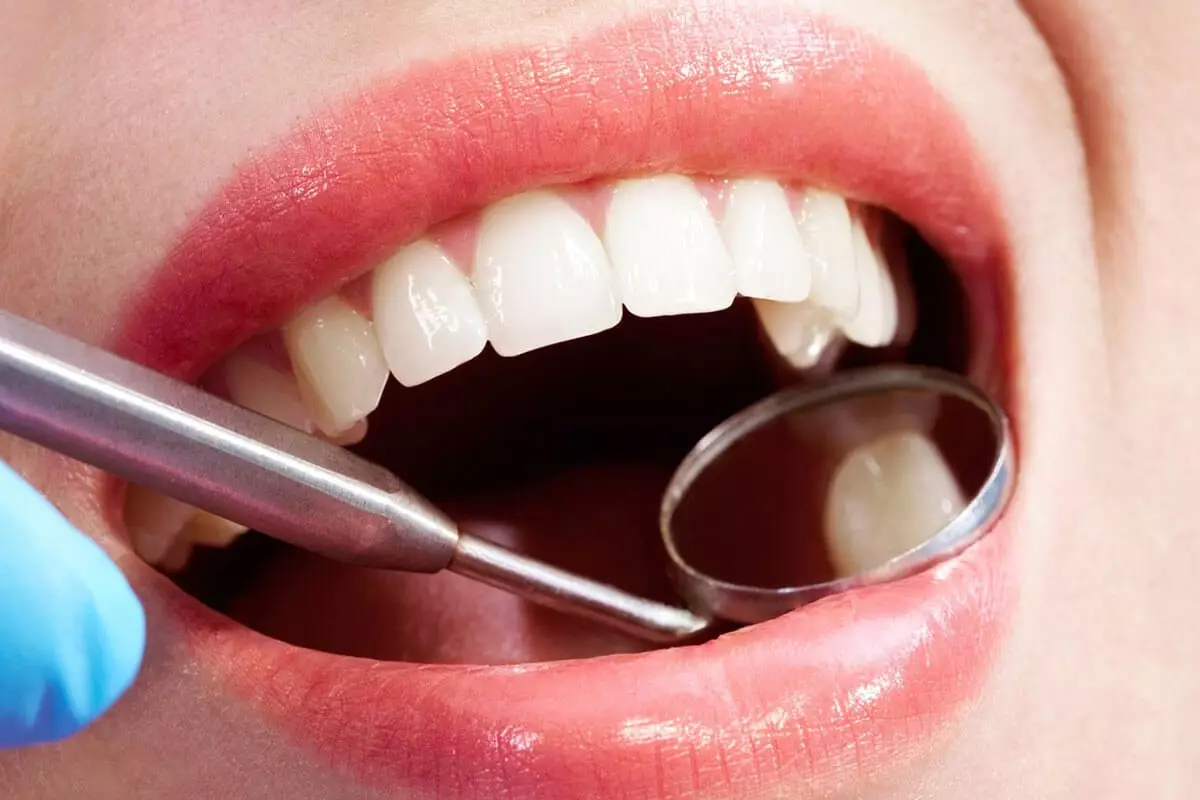 Cavities on front teeth