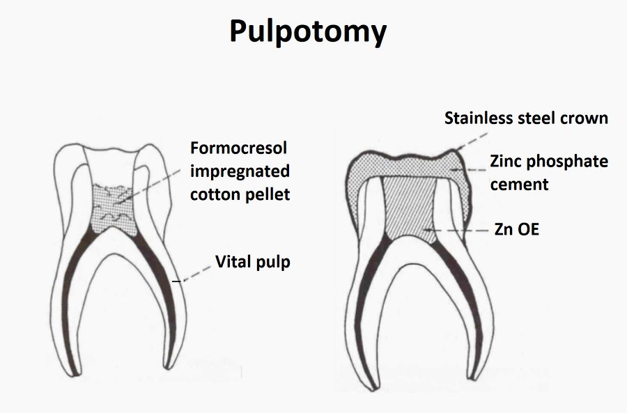 Root canal