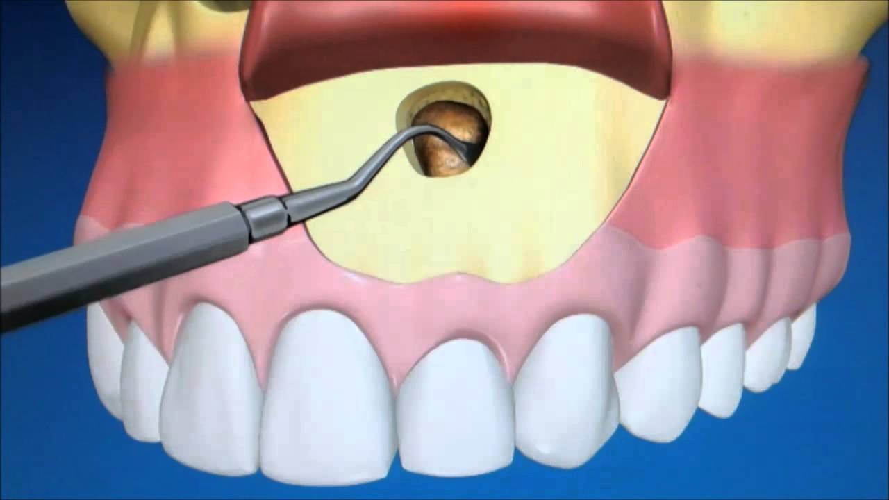 Root canal