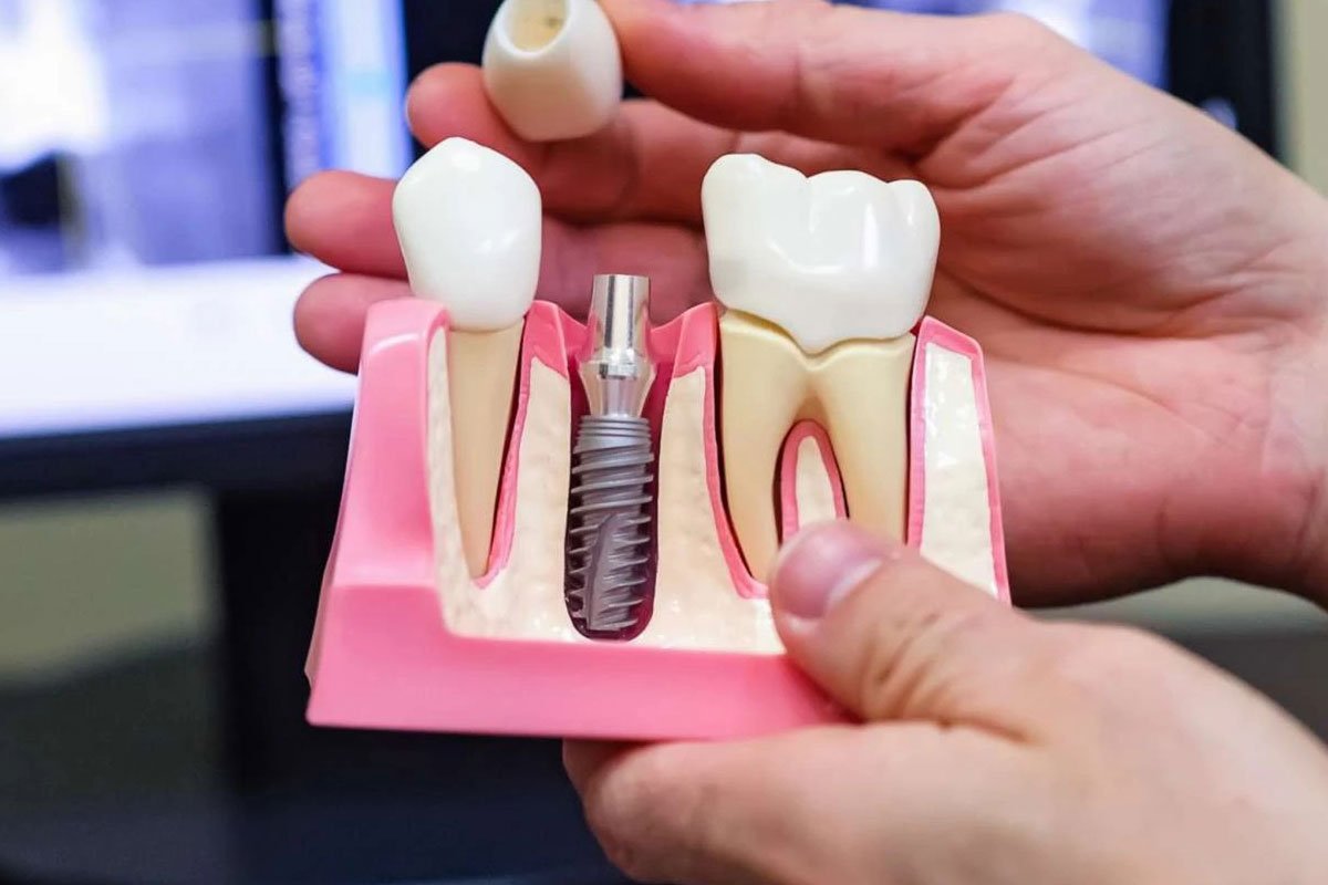 Dental Implants