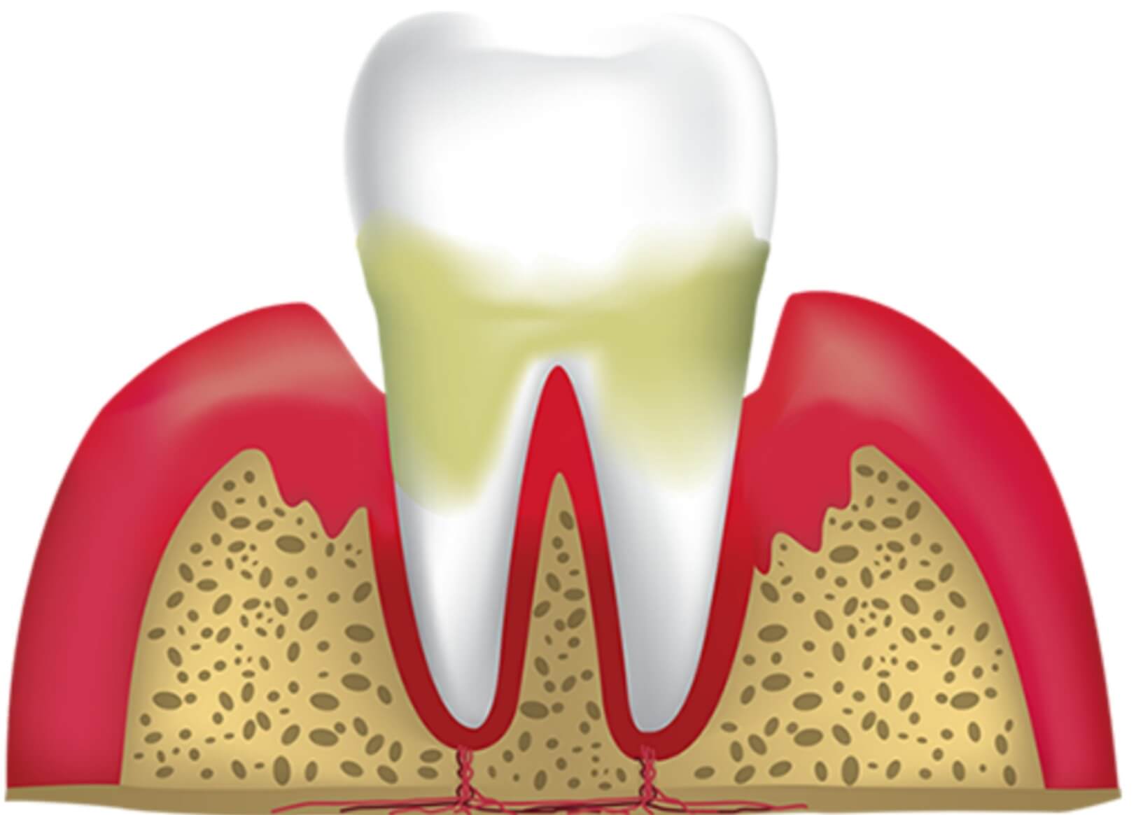 Gum Disease
