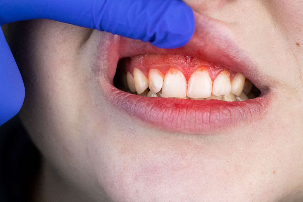 Gum Disease