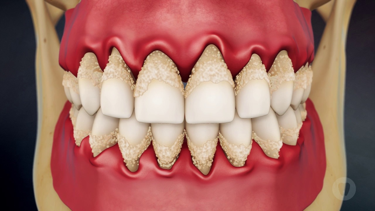 periodontal diseases