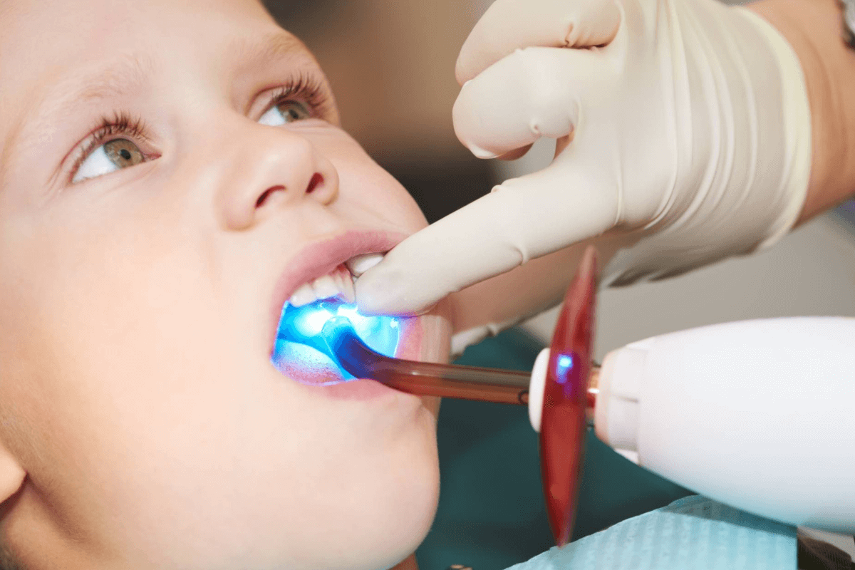 Teeth Filling