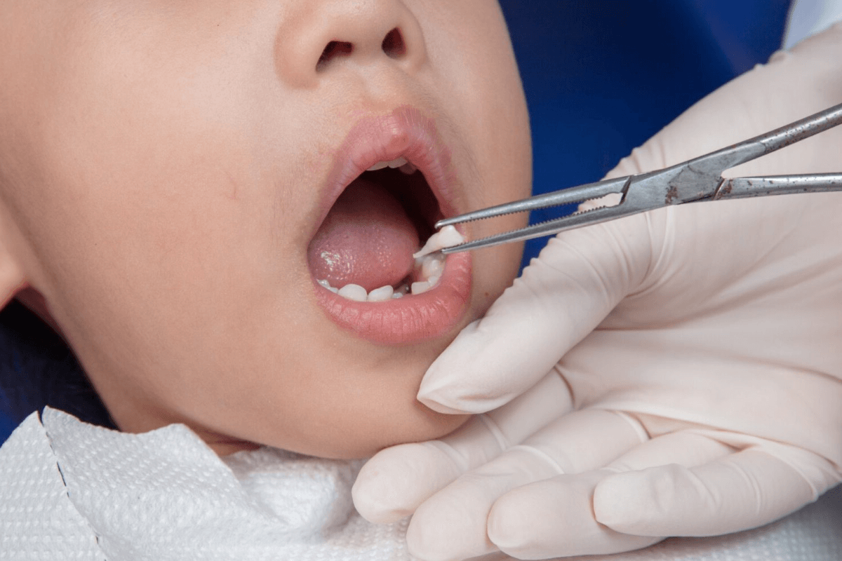 Tooth Extraction